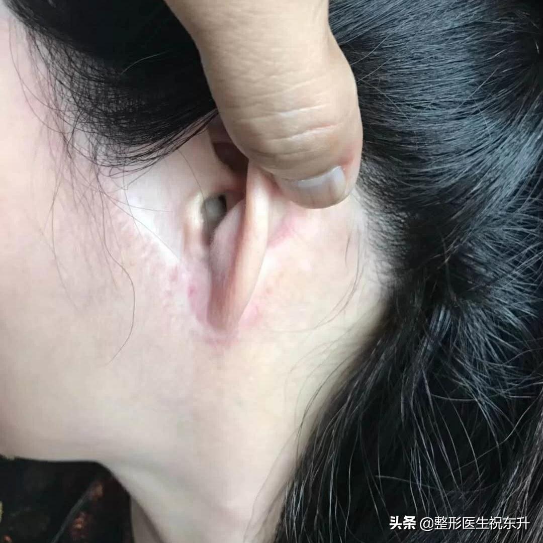 去皱整容的危害到底有多大,整容拉皮和脸部提升的区别