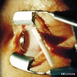 一直流泪是泪道病吗,容易流眼泪是不是泪道阻塞