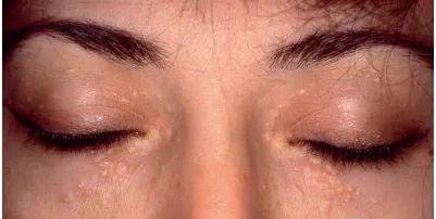 脸上长了闭口小颗粒怎么去除,脸上白色颗粒怎么去除