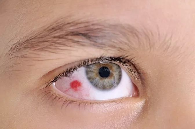 孩子眼白有小黑点是什么原因,儿童眼白有黑点是什么原因