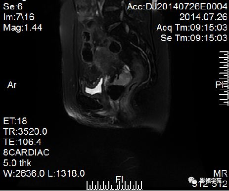 宫颈癌mri诊断,宫颈癌的mr扫描技术