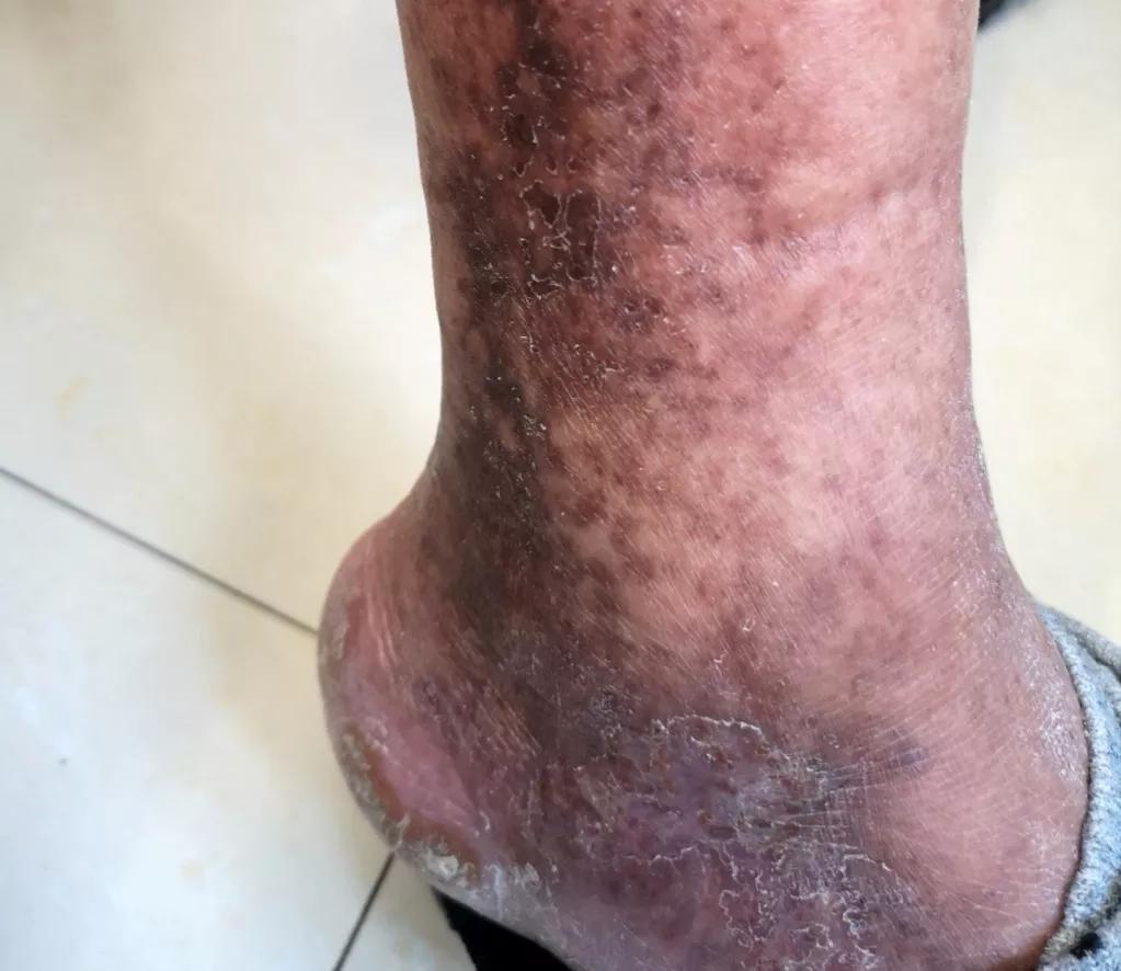 色素性紫癜性皮肤病是啥,色素性紫癜性皮肤病是什么