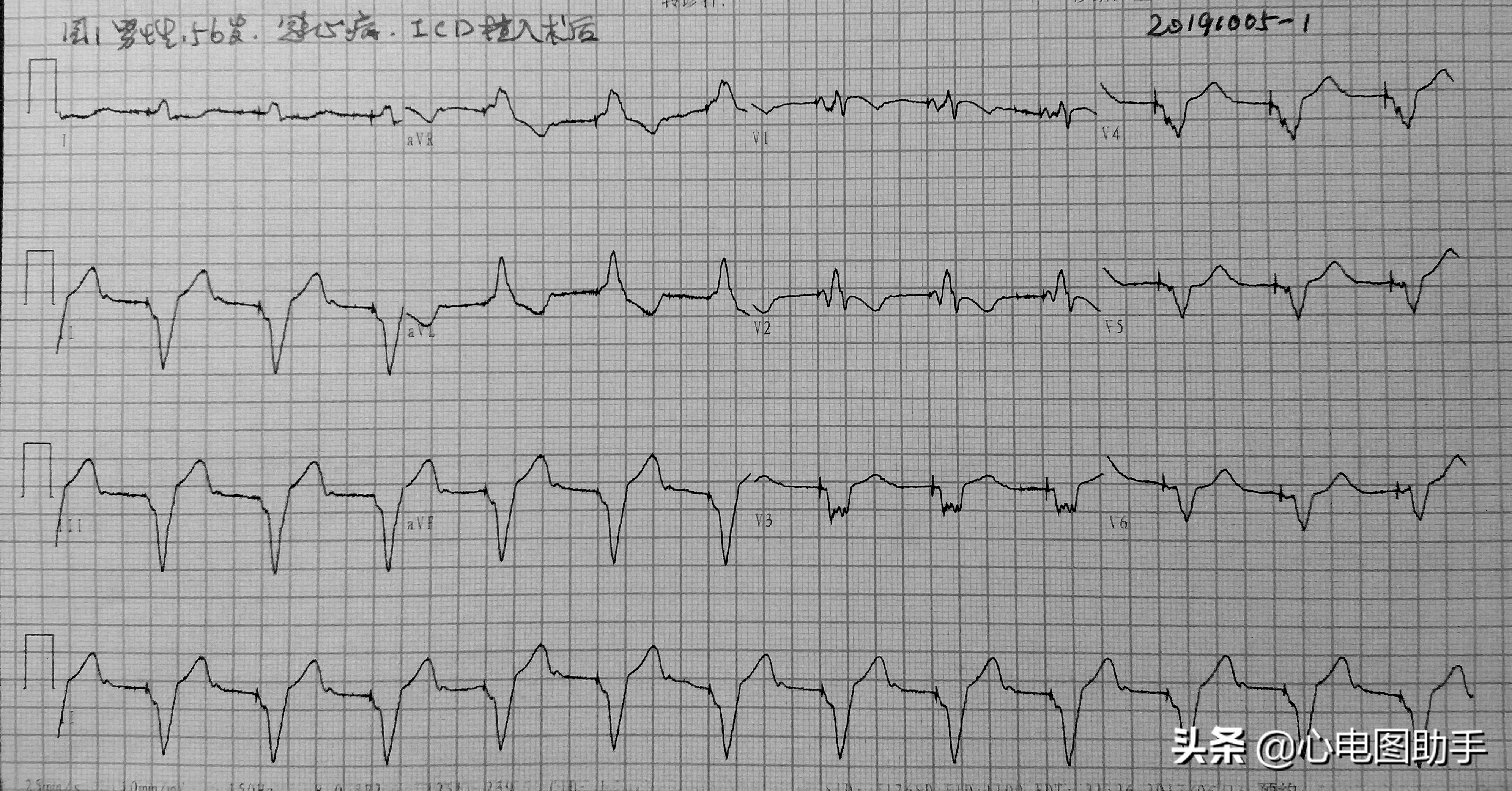 一度房室阻滞可能下壁心肌梗死,心室保护性起搏