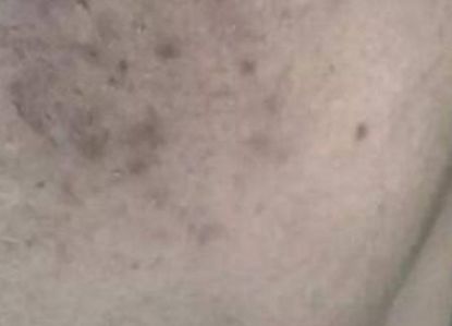 脸上的痘痘痘印怎么消下去,红痘印一直消不下去怎么办