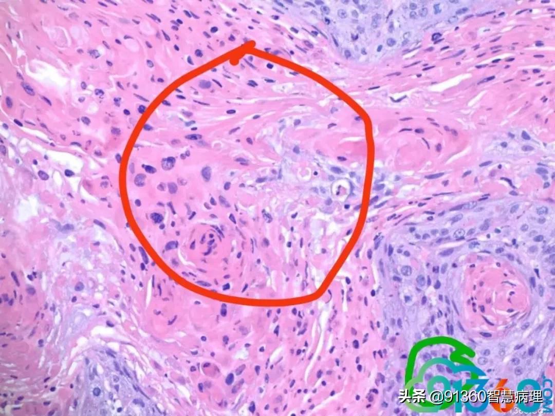 病理宫颈活检lsil是什么意思,宫颈病理检查与tct检查的区别