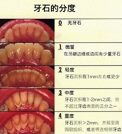 牙齿发黄有菌斑怎么办,牙齿泛黄很脏怎么办
