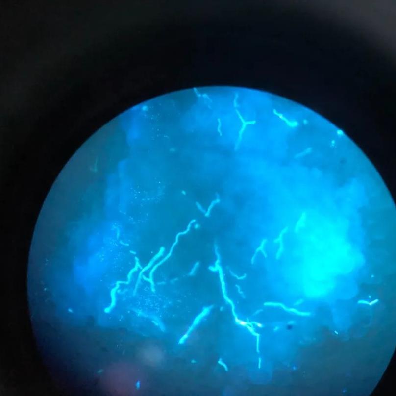 脚上干裂居然是真菌惹的祸