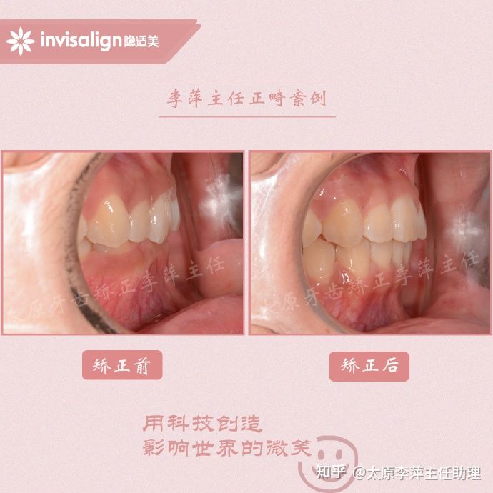 太原矫正牙齿需要做正颌吗,太原牙齿二次矫正