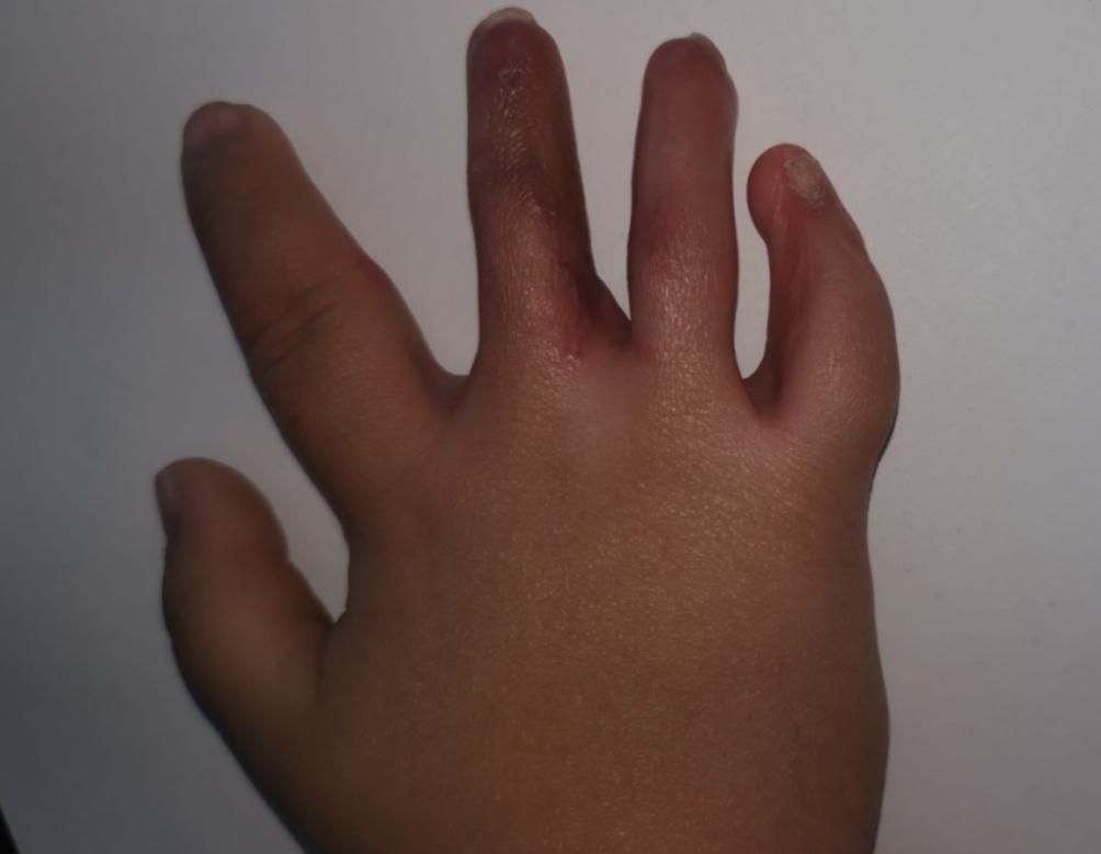 并指畸形免植皮案例,并指畸形