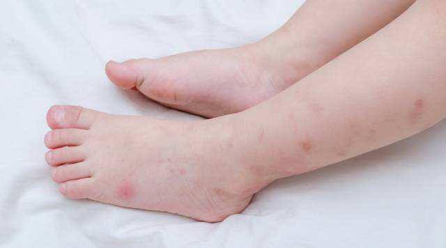 夏天蚊虫多给宝宝们备起来,夏季外出宝宝防蚊虫最有效