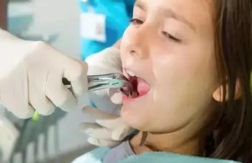 拔牙后的血洞是什么样的,拔牙后血窟窿恢复视频