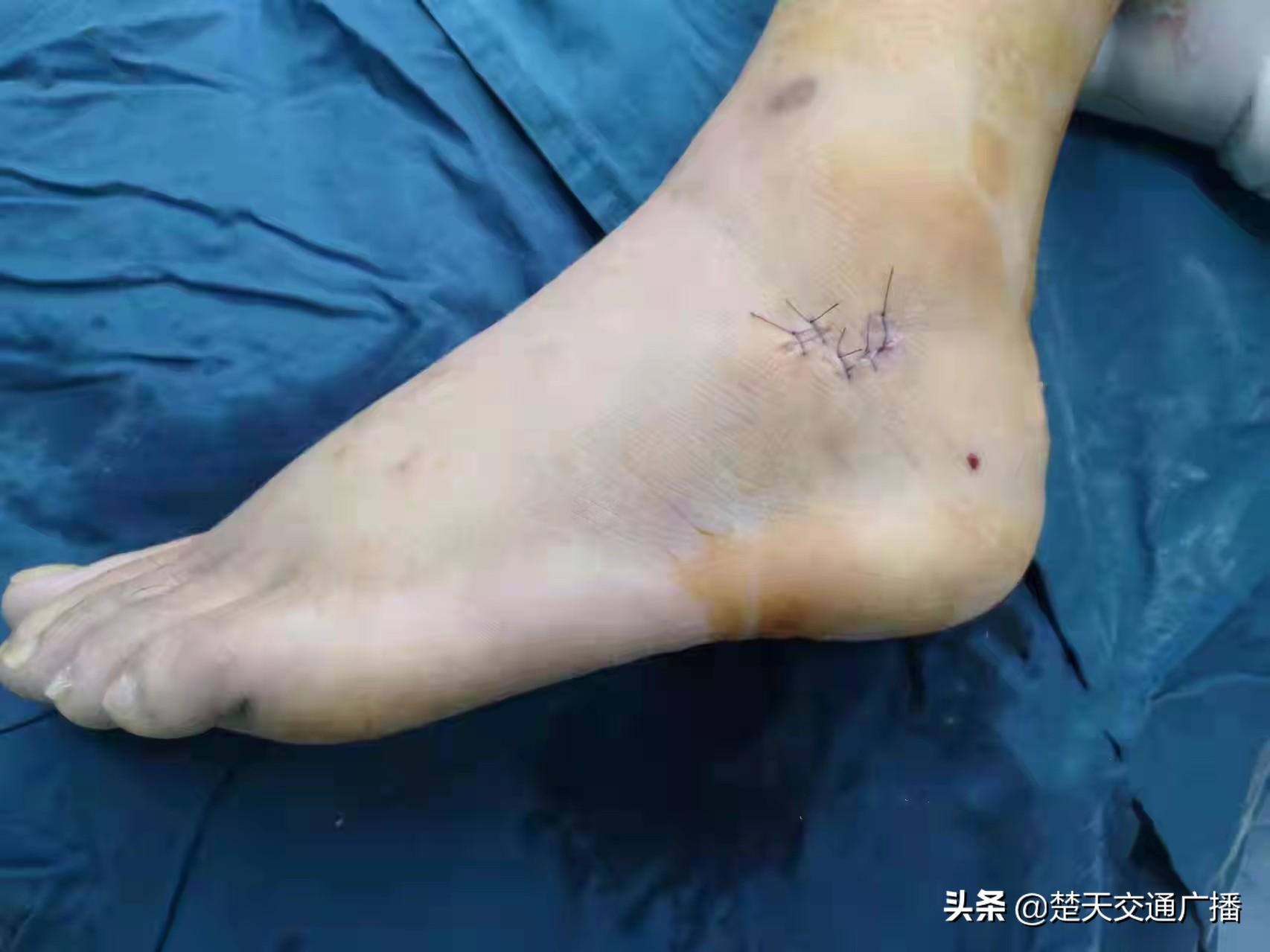 跟骨骨折切开复位的核心技术,跟骨粉碎性骨折3d复位视频