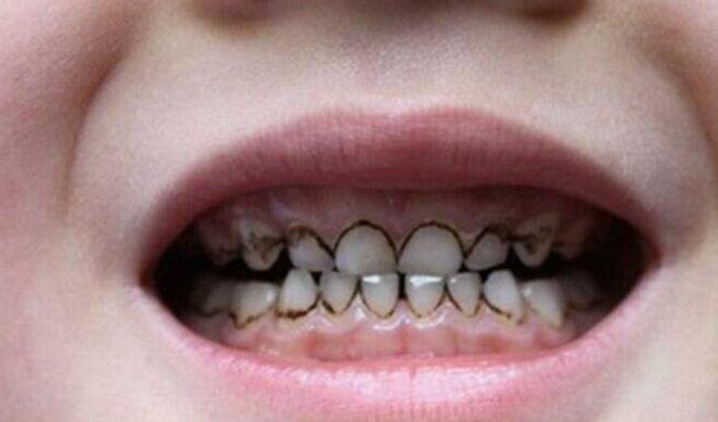 每晚坚持刷牙宝宝的牙齿怎么还黑,为什么宝宝每天刷牙牙齿还是黑的