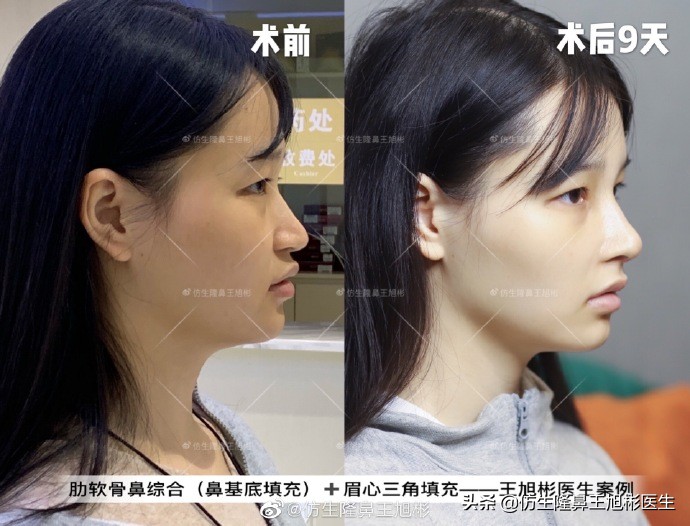 长文+多案例预警！我们所说的「幼态鼻」，到底“幼”从何来？