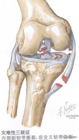 膝关节内侧副韧带损伤的诊疗进展,膝关节内侧副韧带损伤的正确叙述