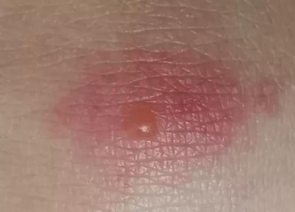 丁丁被蜜蜂叮了会怎么样,钓鱼被蚊虫咬出包怎么办