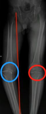 痛风膝关节红肿疼痛如何快速消除,膝关节痛风性关节炎mri表现