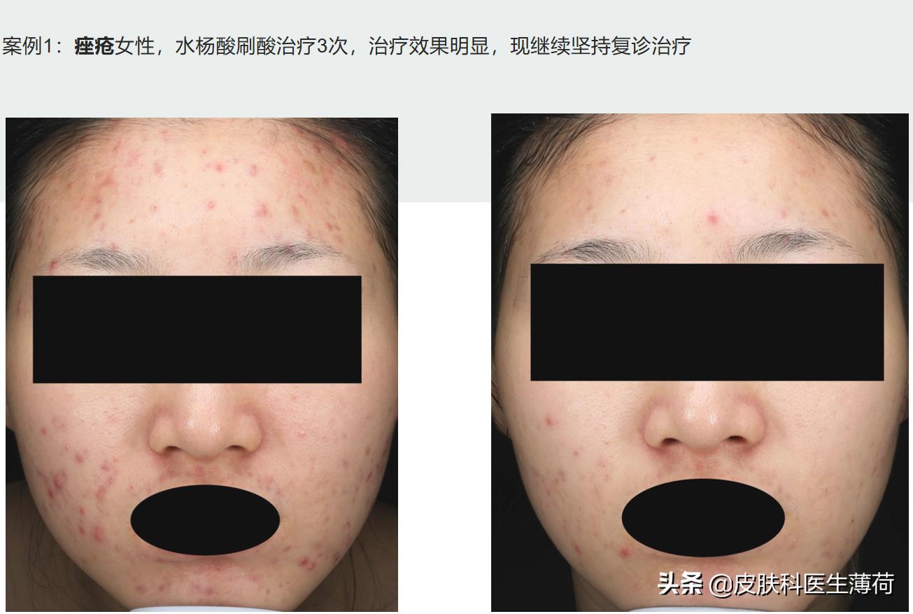 水杨酸果酸毛孔收缩精华测评,水杨酸精华适合所有痘肌