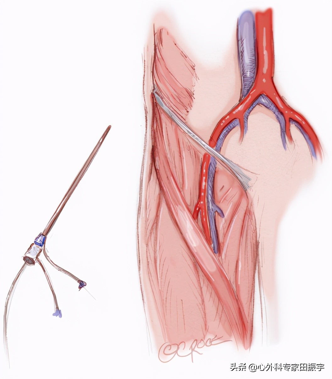 主动脉夹层破裂b型,急性主动脉夹层动脉瘤破裂