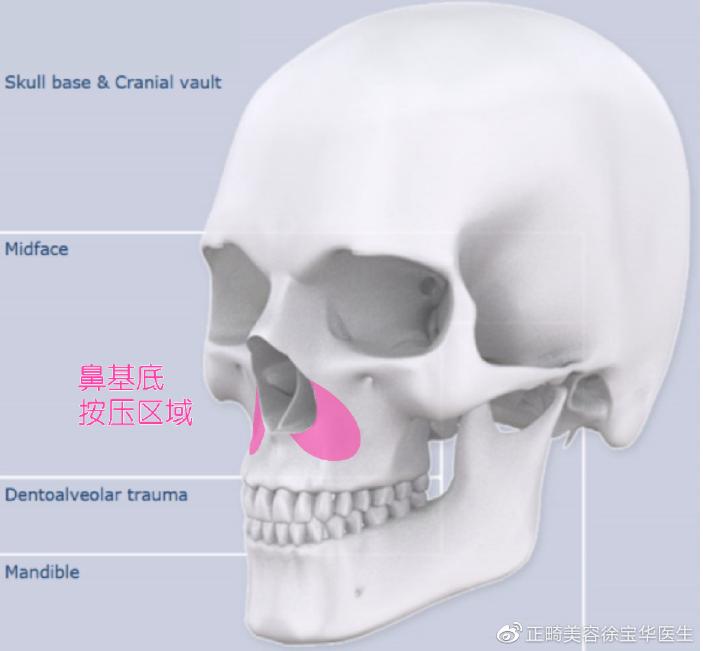 骨性龅牙怎么弄,如何判断骨性龅牙的轻重程度