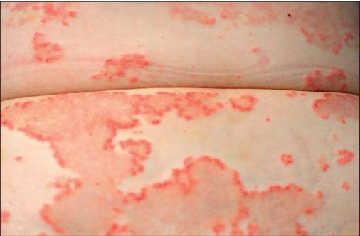 干燥综合症最怕的三种食物,干燥综合症的8大临床特征