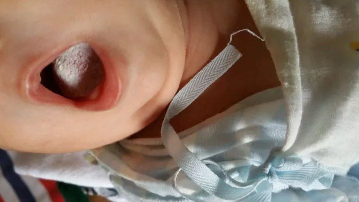 「雪口病」宝宝嘴里有“棉絮”，根本擦不掉