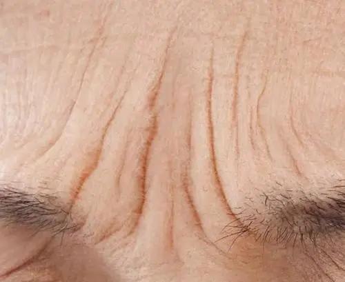 重度眉间纹,说说心里的那些事