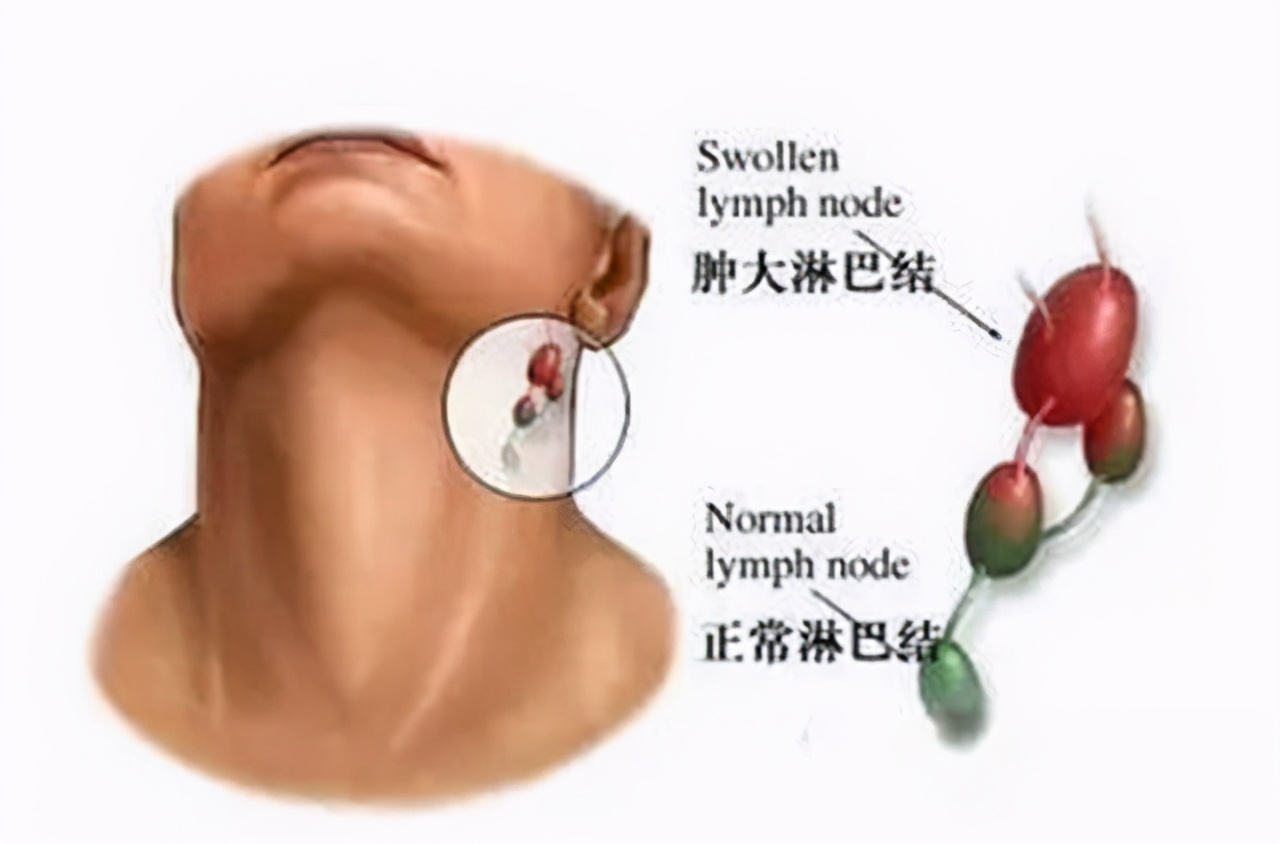 鼻咽癌治疗后前三个月复发征兆,鼻咽癌癌晚期死前24小时征兆