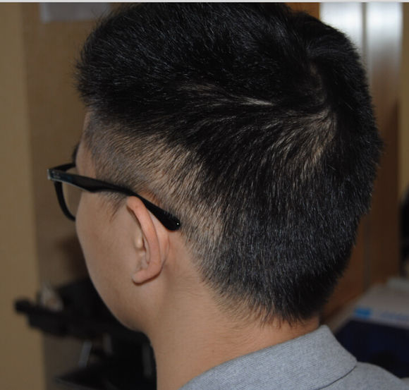 亲身经历脱发怎么治,脱发严重怎么办如何快速治脱发