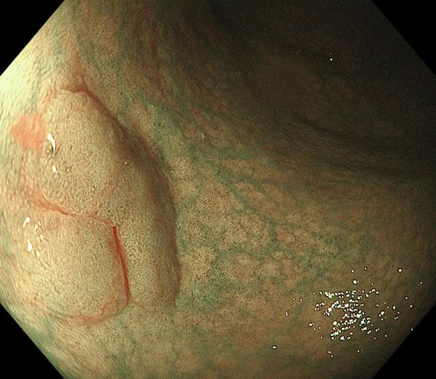 胃镜下黏膜剥离手术护理,内镜黏膜下肿瘤剥离术
