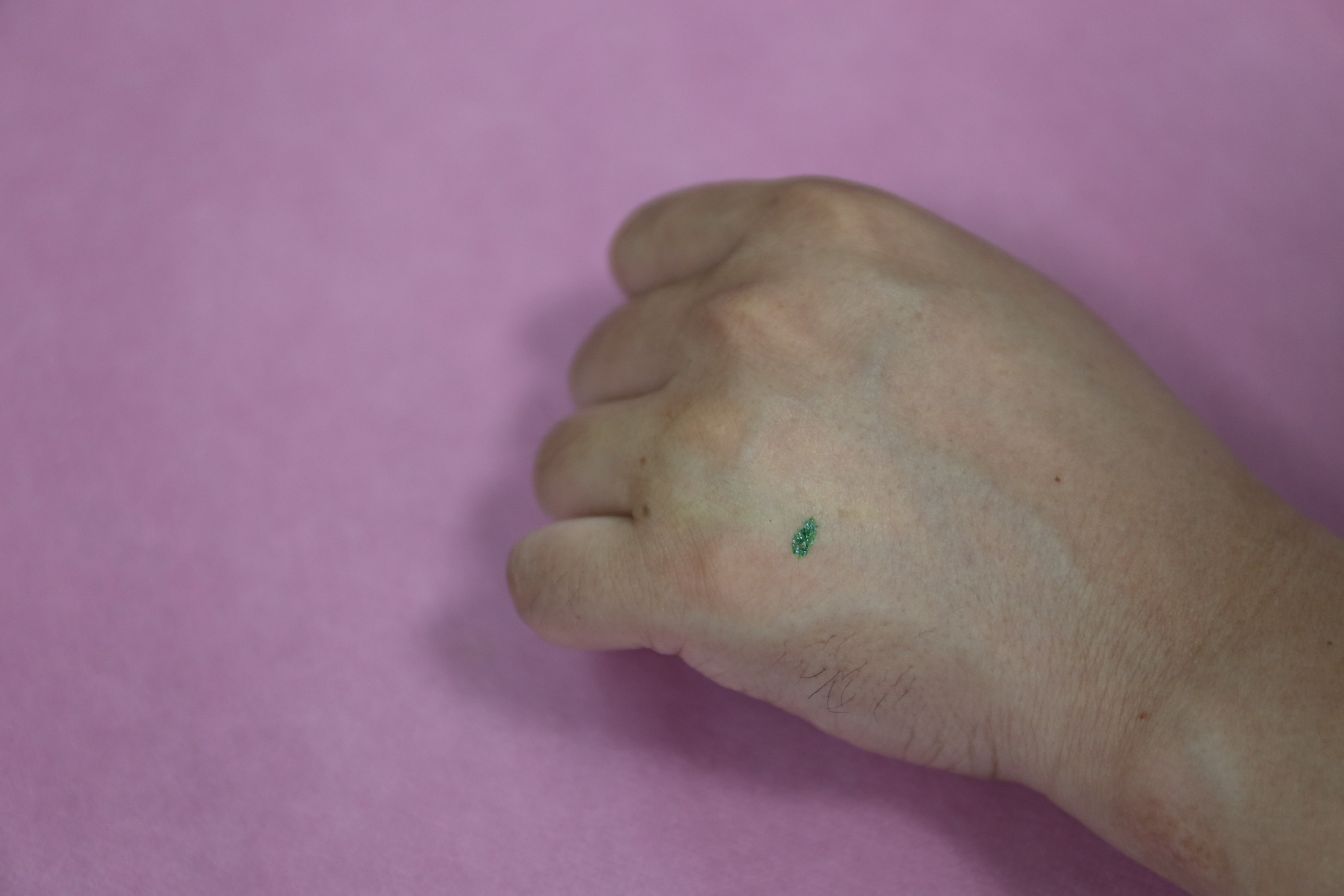 突发性耳聋轻度怎么治疗,颞下颌关节紊乱耳朵会不会聋