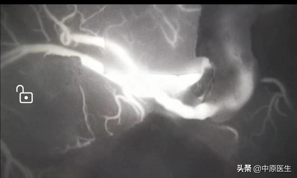 神经外科专家聊烟雾病,神经外科专家烟雾病