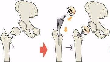 老年人腿粉碎性骨折手术要多少钱,老年人髋骨骨折后一年死亡率