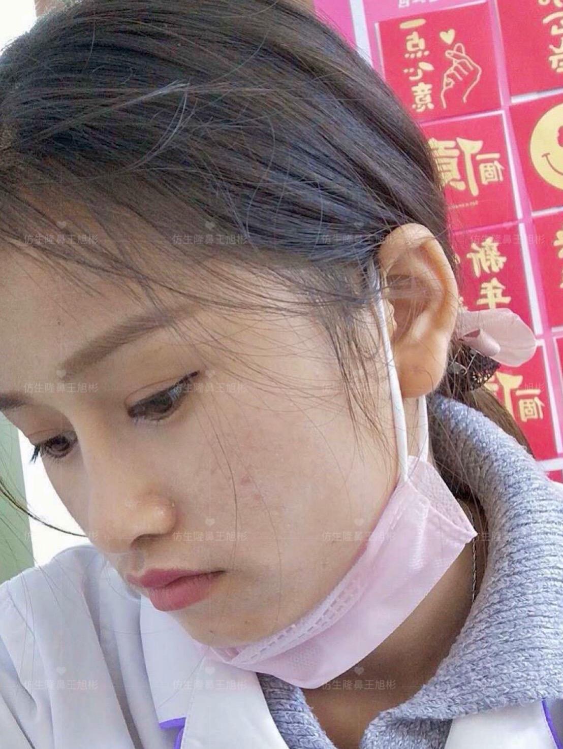 山根低鼻头大隆鼻,鼻根很低的隆鼻后的效果