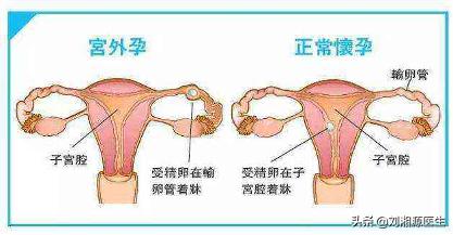免疫问题怀孕必须保胎吗,免疫不良妊娠怎么检查