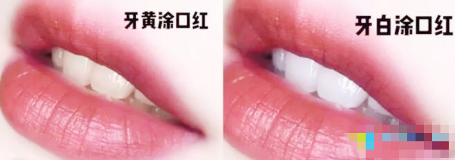 皓齿和冷光美白牙齿哪个好,效果好的牙齿冷光美白成功案例