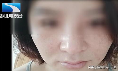 假体耳软骨隆鼻六天伤口流脓,花费近三万元隆鼻鼻子竟然变歪了