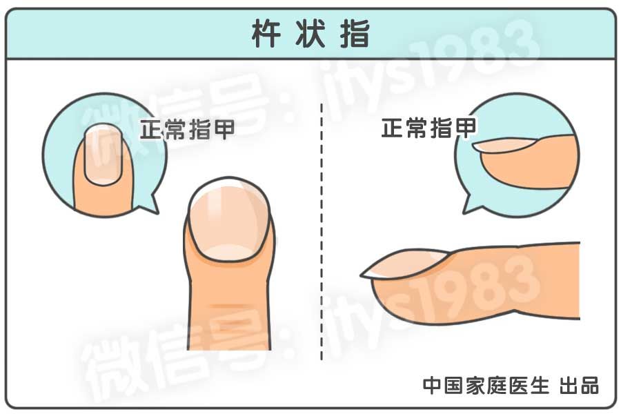 指甲全是竖条纹和白点是怎么回事,指甲竖条纹没有月牙怎么回事