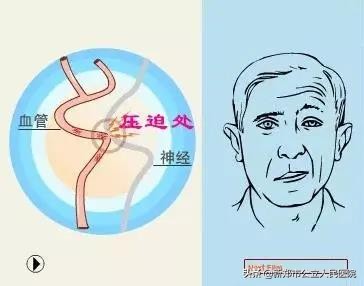 儿童面肌痉挛会频繁眨眼吗,面肌痉挛眨眼耳朵响怎么治疗