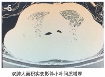 新冠肺炎胸片影像学表现有哪些,新冠肺炎患者轻微症状肺部ct表现