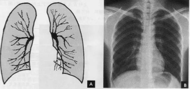 详细的胸部X线解剖，最基础最实用！