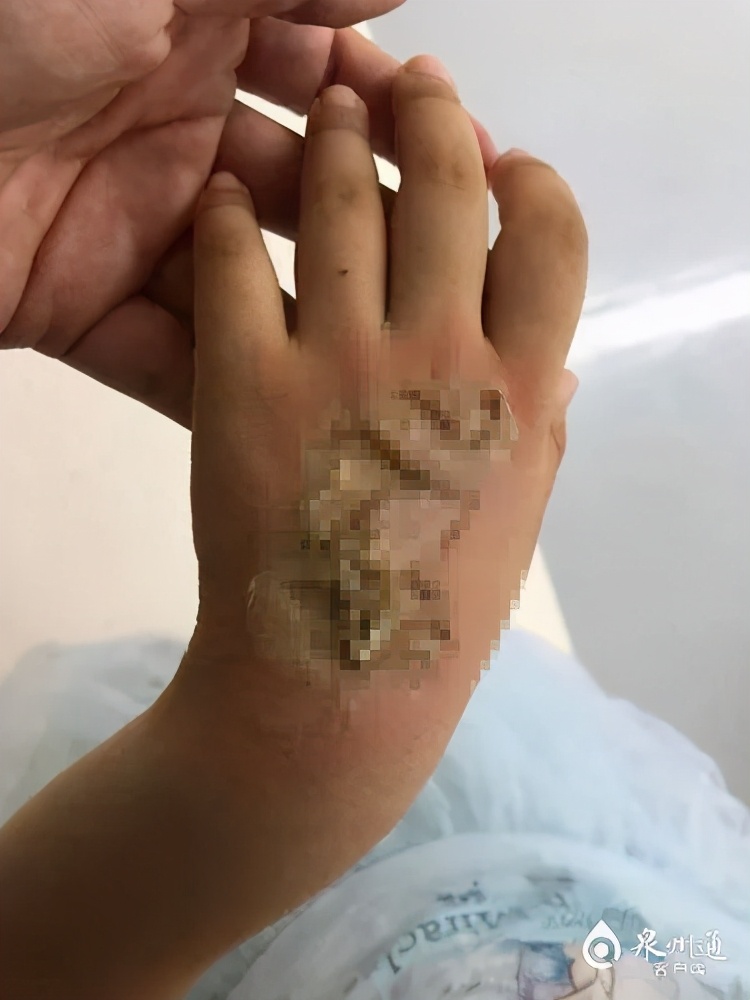 三度烧伤就是整个皮肤组织坏死,三度烧伤严重程度