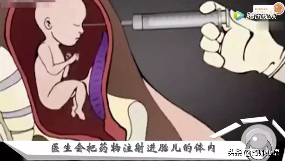 人工流产术是常用的避孕方法吗,流产的几种方式25-28周