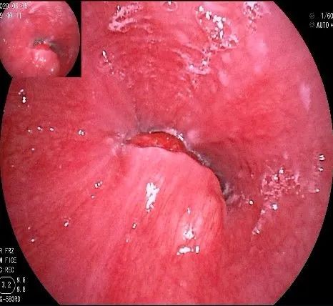 贲门处见隆起性病变,贲门高级别瘤变esd术后不能吃什么