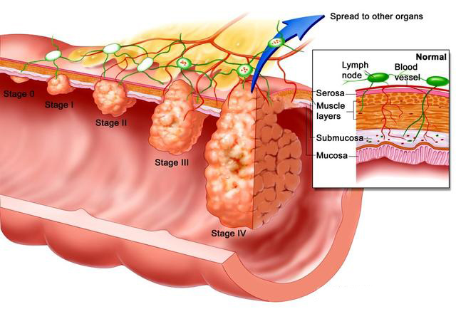 直肠手术后出现便秘或腹泻怎么办？