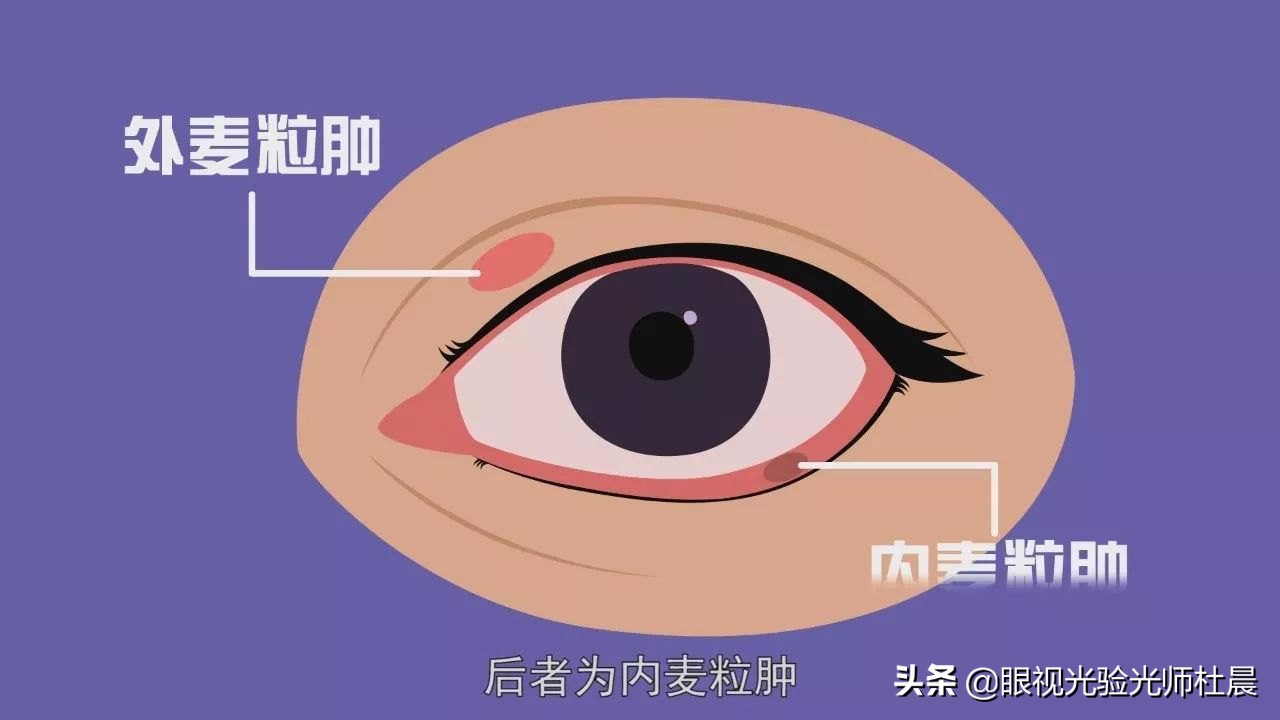 宝宝眼睛长了麦粒肿是什么原因,小婴儿眼睛上火长麦粒肿怎么办