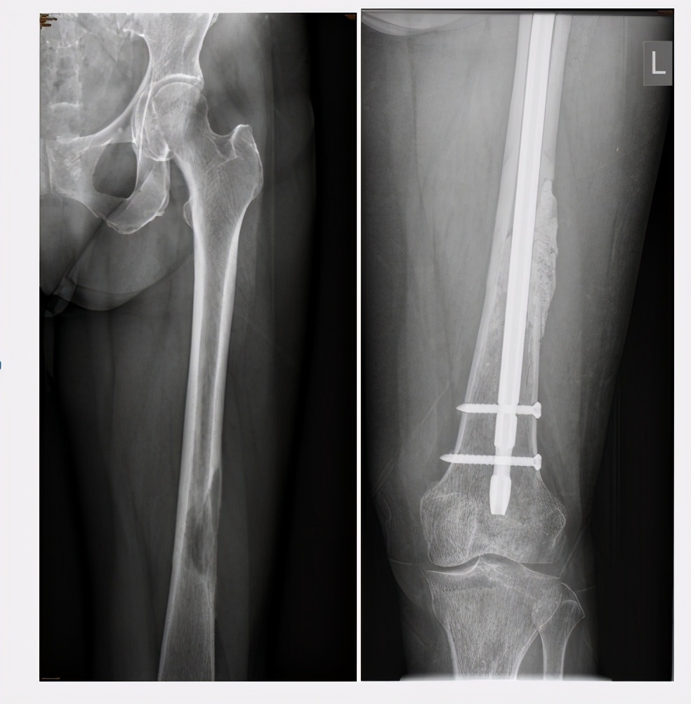 深入骨髓的痛!30年前不能治的骨转移,现在或有3个机会