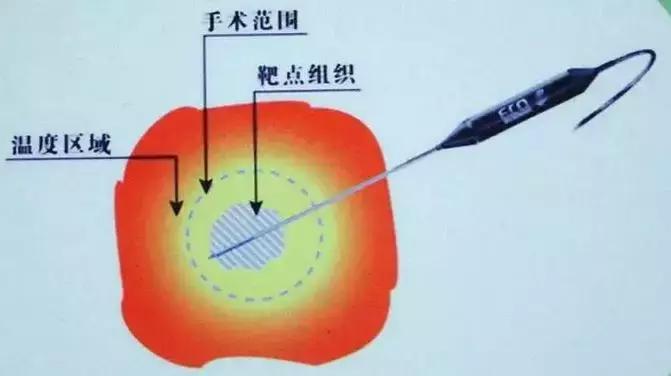 晚期癌症怎么能治,治疗癌症肿瘤的方式都有哪些