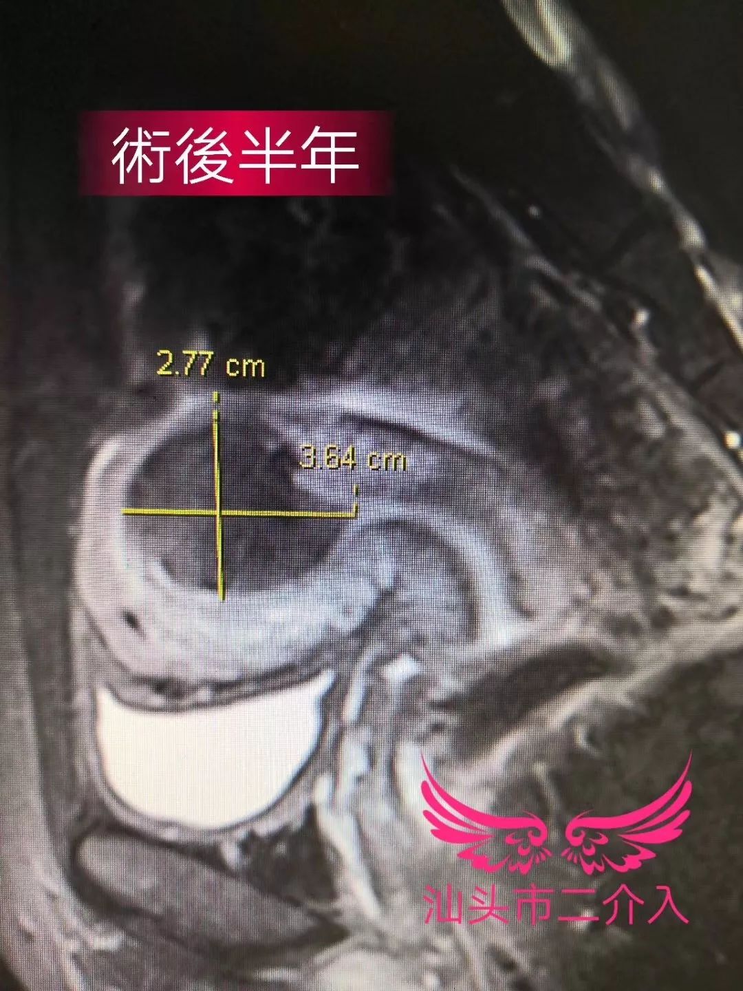 子宫肌瘤无创消融手术,无疤痕子宫肌瘤手术
