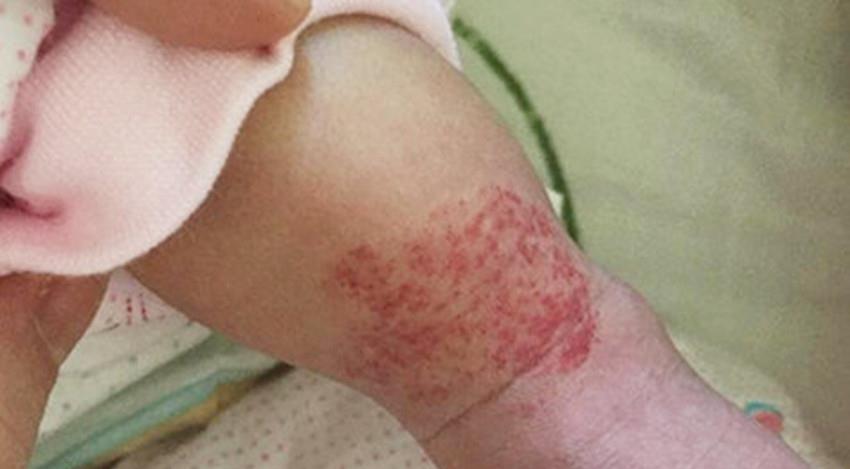 新生儿治血管瘤需要打消炎针吗,新生儿颅内血管瘤能治愈吗